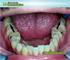 Son los terceros molares capaces de apiñar los dientes anteroinferiores?