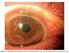 Alteraciones oftalmológicas en el curso de la artritis reumatoide y derivadas de su tratamiento