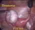 Ginecología. Tratamiento quirúrgico del teratoma quístico benigno. Surgical treatment of benign cystic teratoma