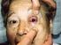 Manifestaciones oftalmológicas de la fístula carótido-cavernosa: a propósito de 3 casos