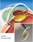 Cálculo del poder de la lente intraocular mediante biometría ultrasónica