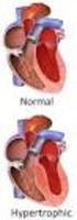 - Miocardiopatía Hipertrófica -