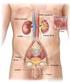 Tratamiento de cálculos asociados con anatomía renal compleja o anómala