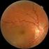 Desprendimiento de retina seroso en un paciente con preeclampsia: utilidad de la Tomografía de Coherencia Óptica
