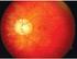 Estado de la retina en pacientes miopes