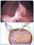 Cirugía laparoscópica en la apendicitis aguda