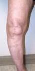 Artroplastia total de rodilla en pacientes con artritis reumatoide