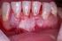Injerto gingival libre como tratamiento profiláctico en un paciente de ortodoncia