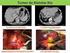 Efectividad de la gastrectomí a total ampliada por cáncer de cardias y fondo del estómago