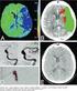 Hemicraniectomía en pacientes con ataque cerebro vascular isquémico extenso: aspectos relevantes a propósito de una serie de casos