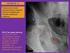 Fractura acetabular compleja: valoración radiológica en la urgencia