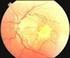 Frecuencia de estrabismo en pacientes con retinopatía de la prematuridad