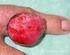 Lesión cutánea recidivante en paciente trasplantado renal
