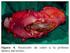 Prótesis endoluminal autoexpandible en una oclusión aguda por tumor del colon izquierdo