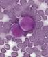 Leucemia mieloide aguda en adultos: Estudio comparativo sobre tratamiento y pronóstico por grupos etarios