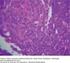 Hiperplasia linfoide reactiva del hígado en un paciente con cáncer de colon: presentación de un caso