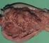 Carcinoma de células transicionales de vejiga urinaria con diferenciación Coriocarcinomatosa