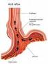 Enfermedad por reflujo gastroesofágico Clínica y tratamiento