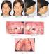 Prevalencia de forma de los arcos dentales en adultos con maloclusión y sin tratamiento ortodóncico