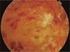 Oclusión de rama arterial asociada con retinocoroiditis por toxoplasmosis. Dr. Ariel Prado Serrano
