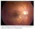 Toxocariosis humana en pacientes con lesión ocular