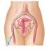 Leiomiomas uterinos: estudio pre y post-embolización mediante RM.