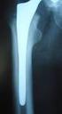 El cementado y su posible relación con la infección aguda en las artroplastias totales de cadera