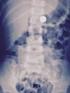 Radiografía seriada del tubo digestivo superior