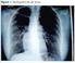 Todas las anomalías de drenajes de las venas pulmonares se deben a una alteración