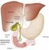 La Colelitiasis, sus complicaciones y el Cáncer vesicular