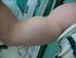 Rotura distal del tendón de la porción larga del bíceps braquial. Por qué está aumentado su incidencia? Cuándo se debe reparar?