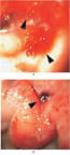 Úlcera gastroduodenal en pacientes con hemorragia digestiva alta