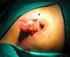 Reporte de lesiones no palpables diagnosticadas por mastografía en el Hospital General de México