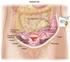 Diagnóstico precoz de la carcinomatosis peritoneal, un desafío para el radiólogo