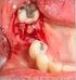 Manejo de la hemorragia con anticoagulantes orales directos