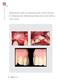 Regeneración ósea con sobrecontorneo a nivel radicular en restauraciones implantosoportadas de la zona estética. Caso clínico